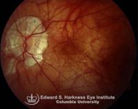 Degenerative Myopia